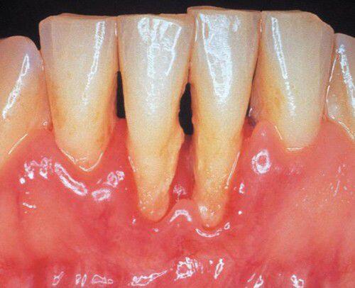 Thói quen xỉa răng và bệnh lý răng miệng