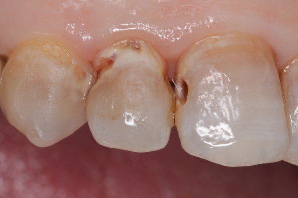 các triệu chứng của bệnh sâu răng