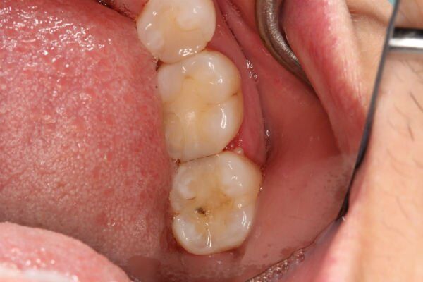 bệnh sâu răng