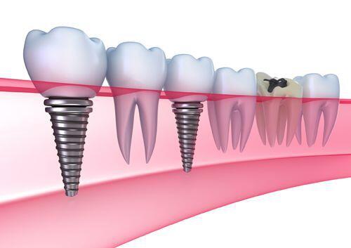 Trồng răng Implant có lợi ích gì ?