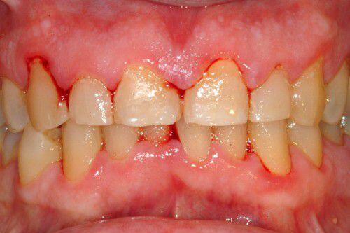 Nguyên nhân gây ra tình trạng chảy máu chân răng
