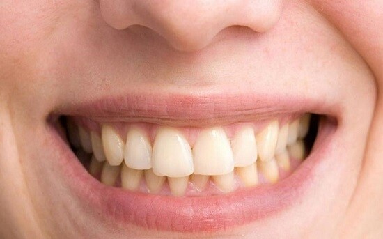 Cách điều trị răng bị nhiễm màu do yếu tố nội sinh
