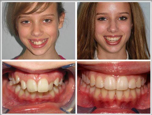2 cách khắc phục răng hô hiệu quả nhất