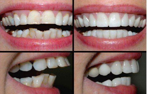 Cách điều trị răng vẩu 