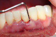 Nguy hiểm từ nha chu và khắc phục bằng cấy răng implant