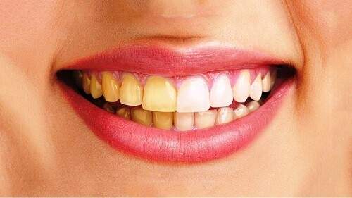 Cách khắc phục răng ố vàng 1