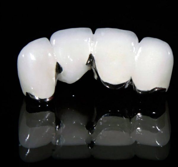 Kết quả hình ảnh cho răng sứ kim loại
