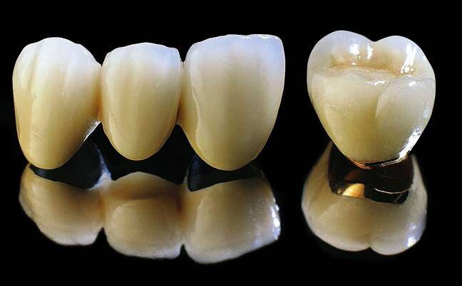 Cách nhận biết răng sứ Titan?