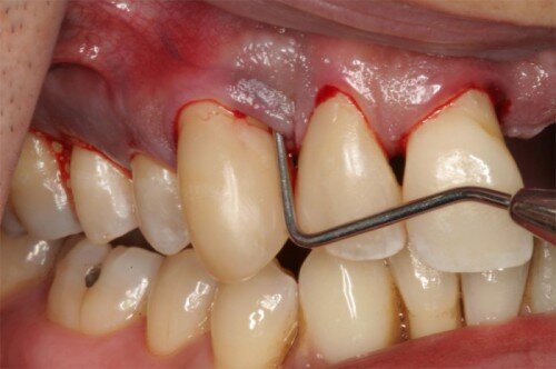 Cách phát hiện sâu răng sớm