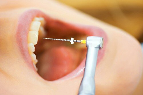 Cách phòng ngừa viêm tủy răng hiệu quả