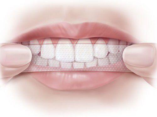 Nguyên nhân khiến răng bị tê buốt sau tẩy trắng