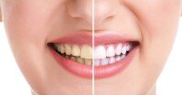 Cách khắc phục răng ố vàng