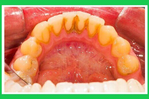 Cao răng và sự hình thành cao răng