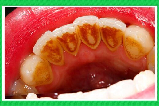 Cạo vôi răng có đau không, có ảnh hưởng đến men răng không?