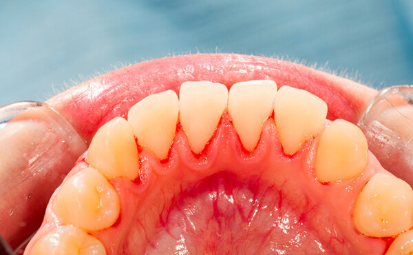 tác hại của cao răng