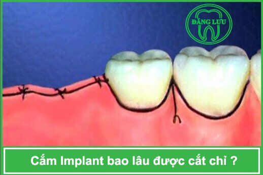 trồng răng implant sau bao lâu thì được cắt chỉ