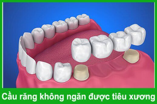 Vì sao cầu răng không ngăn được tình trạng tiêu xương ?