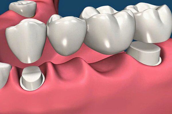 Cầu răng có thể ngăn được tình trạng tiêu xương không ?