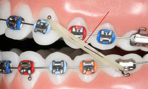 Phương pháp điều trị tình trạng răng mọc chen lấn nhau