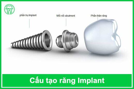 cấu tạo răng Implant