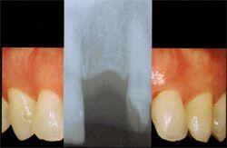 Cấy Ghép Implant Khi Bị Mất Một Răng
