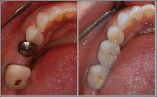 Tại sao xương hàm bị tiêu hủy sau mất răng ?