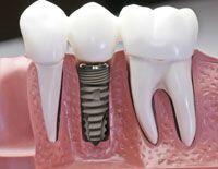 Cấy ghép Implant tức thì sau nhổ răng