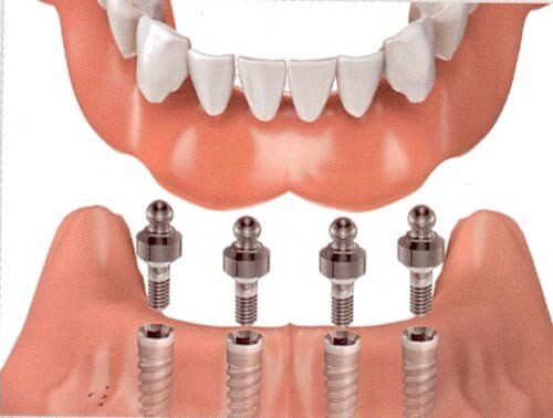 Chăm sóc răng implant thế nào sau phục hình ?