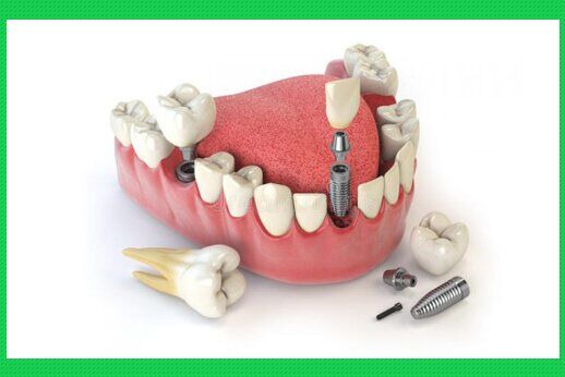 Các cách vệ sinh răng miệng sau cấy ghép Implant hiệu quả