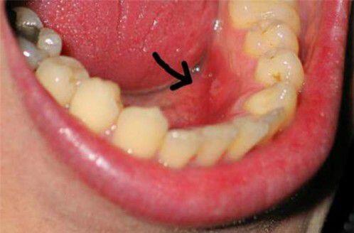 Chân răng có mủ là bệnh lý gì ?
