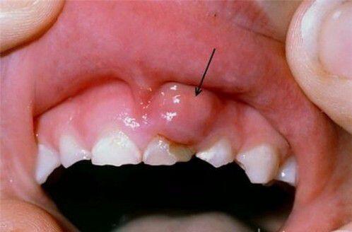Chân răng có mủ là bệnh lý gì ?