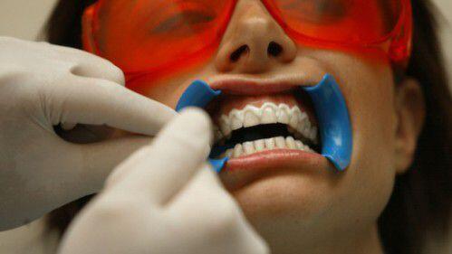 7 sự thật về tẩy trắng răng