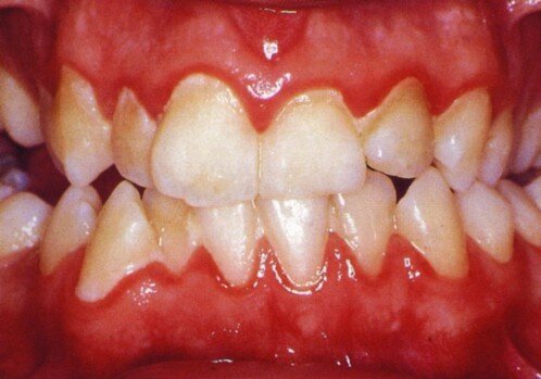 Chảy máu chân răng có gây hôi miệng không ?