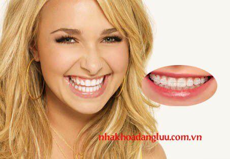 Niềng răng điều trị hô trong bao lâu ?