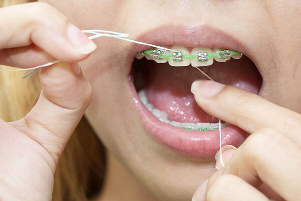 chỉnh hình răng là gì