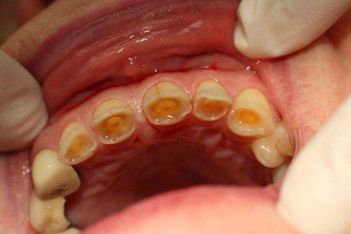 Chữa đau răng do bệnh tủy răng 