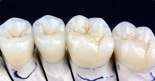 Có nên bọc răng sứ Lava Plus hay không?