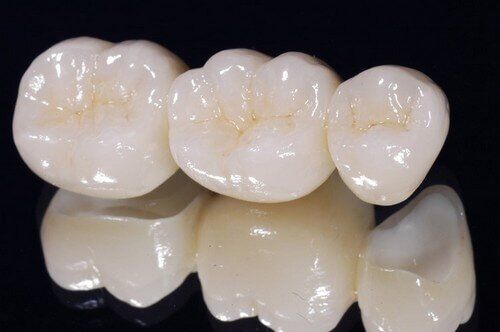 Có nên bọc răng sứ Titan cho răng cửa không ?