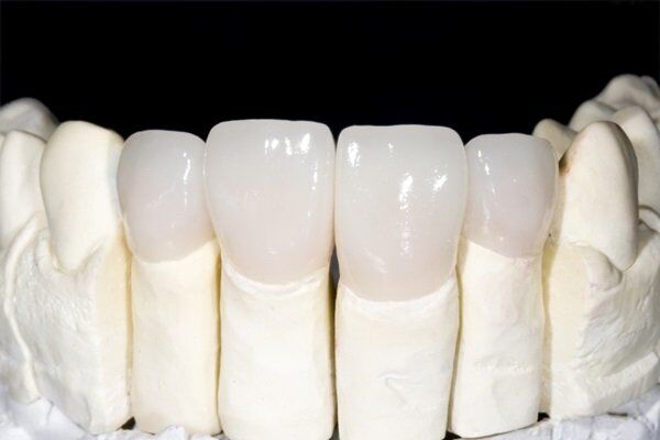 Có nên làm răng sứ Titan cho răng vỡ hay không?