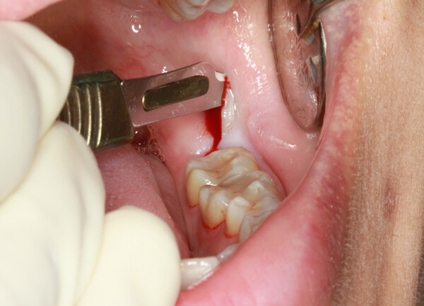 có nên nhổ răng khôn để điều trị viêm lợi trùm