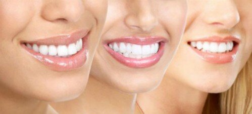 Có nên tự tẩy trắng răng tại nhà không ?