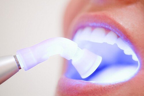 Có thể tẩy trắng răng khi vừa chữa nha chu không ?