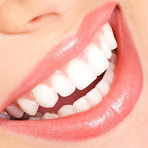 Có thể tẩy trắng răng khi vừa chữa nha chu không ?