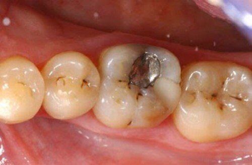 Đang bị sâu răng có niềng được không?