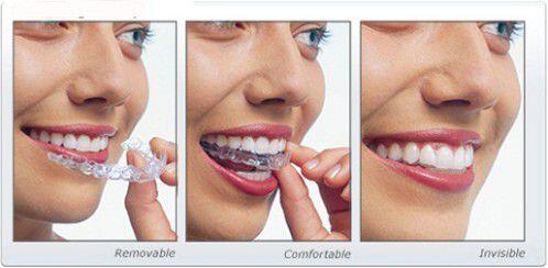 Các loại niềng răng thẩm mỹ hiện nay