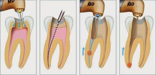 Điều trị tủy răng là gì ?