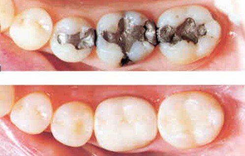 Hàn trám răng và các vật liệu hàn răng