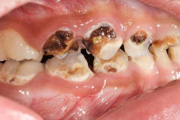 diễn biến nghiêm trọng của bệnh sâu răng