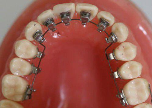 Điều trị chỉnh hình răng kéo dài bao lâu?