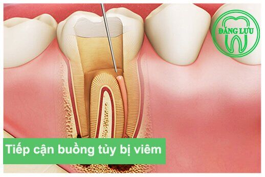 điều trị tủy cho răng bị bong chân